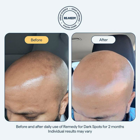 😴😴REMEDY Overnight Serum: Din kraftpaket i kampen mot mörka fläckar