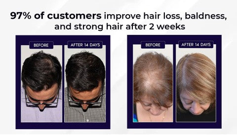 Spray naturale per la ricrescita dei capelli HZA™