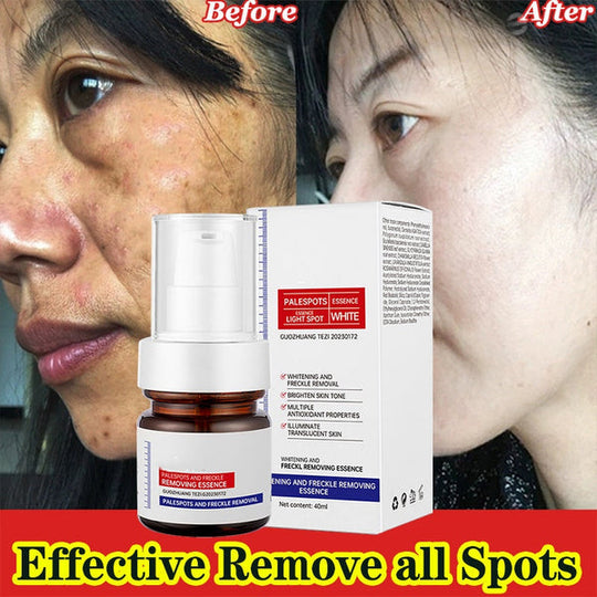 ⚡Illuminante in 5 secondi! Essenza sbiancante per lentiggini alla vitamina C