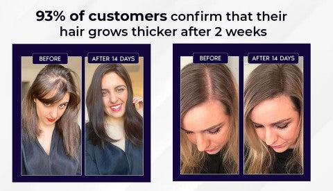 Spray naturale per la ricrescita dei capelli HZA™