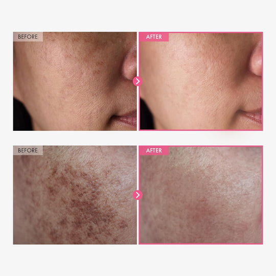 Arbutina 7% + Acido Tranexamico 4% Crema