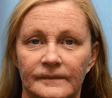 (Tillverkad och skickad från USA) 🧑‍⚕️TLOPA® Botox bigift rynkeborttagningskräm🔥